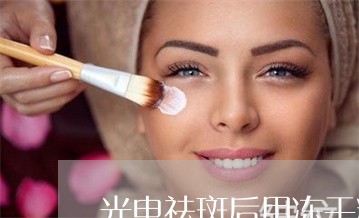 光电祛斑后用冻干粉修复吗