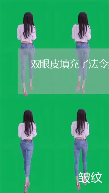 双眼皮填充了法令纹