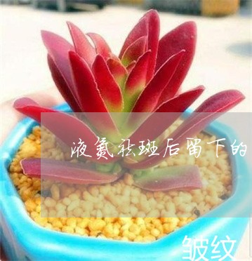 液氮祛斑后留下的色素 液氮祛斑后留下的色素