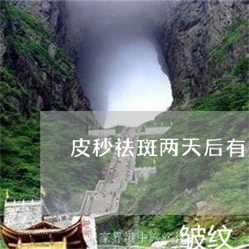 皮秒祛斑两天后有点肿
